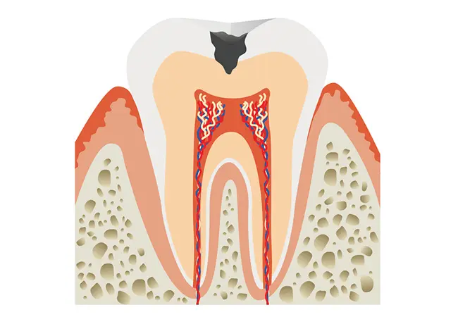 C2:歯の内部の虫歯