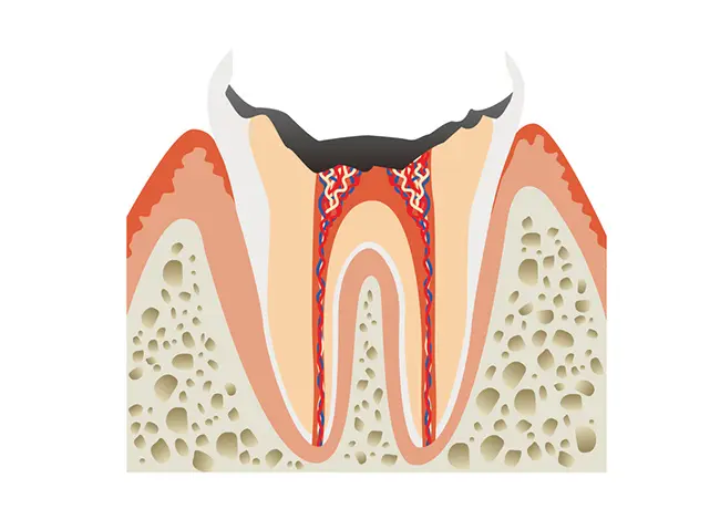 C4:歯根まで達した虫歯