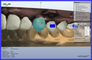 正しい歯並びのデザインや治療のシミュレーション画像